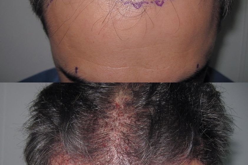 Implante Capilar antes y después - 826566