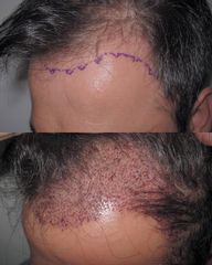 Implante Capilar - Dr Rodrigo Ruiz - RR Clinica