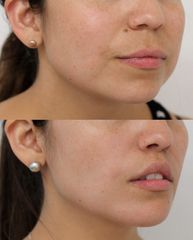 Upper Lip Lift - Dr Rodrigo Ruiz - RR Clinica