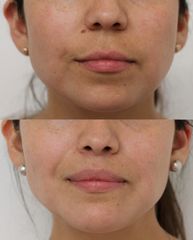 Upper Lip Lift  - Dr Rodrigo Ruiz - RR Clinica