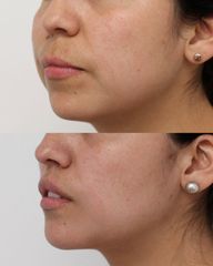 Upper Lip Lift - Dr Rodrigo Ruiz - RR Clinica