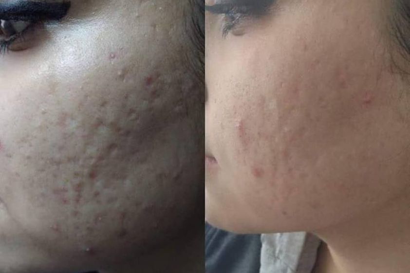 Tratamiento acné antes y después - 643155