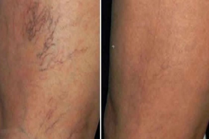 Tratamiento de várices antes y después - 501752