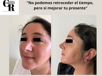 Rinoplastía antes y después - 871309