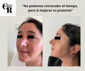 Rinoplastia - Dr Christian Salem Zamorano