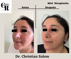 Rinoplastia - Dr Christian Salem Zamorano