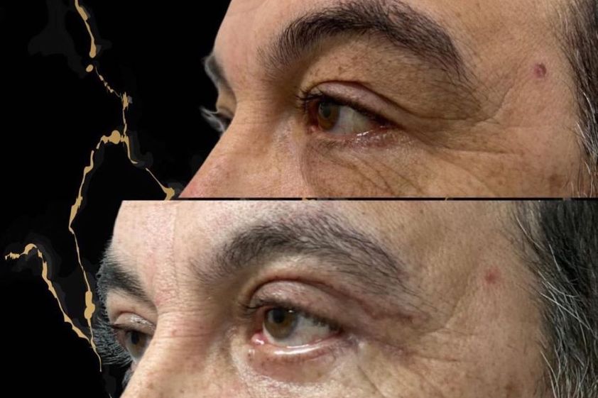 Blefaroplastía antes y después - 871311