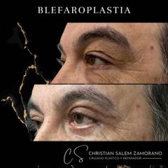 Blefaroplastia - Dr Christian Salem Zamorano