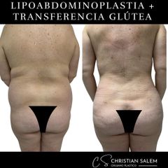 Liposucción - Dr Christian Salem Zamorano