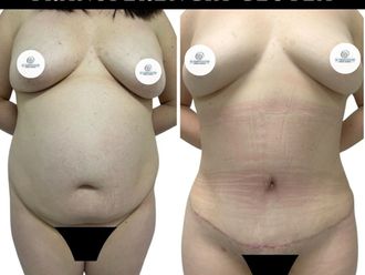 Abdominoplastía antes y después - 871319