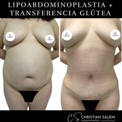 Abdominoplastia - Dr Christian Salem Zamorano