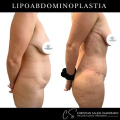 Abdominoplastia - Dr Christian Salem Zamorano