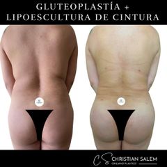 Liposucción - Dr Christian Salem Zamorano