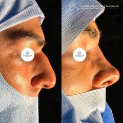 Rinoplastia - Dr Christian Salem Zamorano