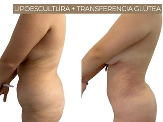 Lipoescultura antes y después - 871326