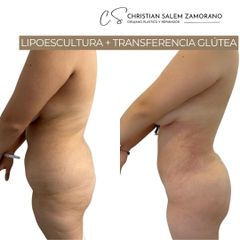 Lipoescultura - Dr Christian Salem Zamorano