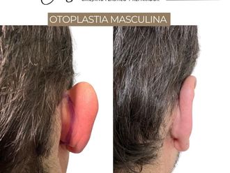 Otoplastia antes y después - 871327