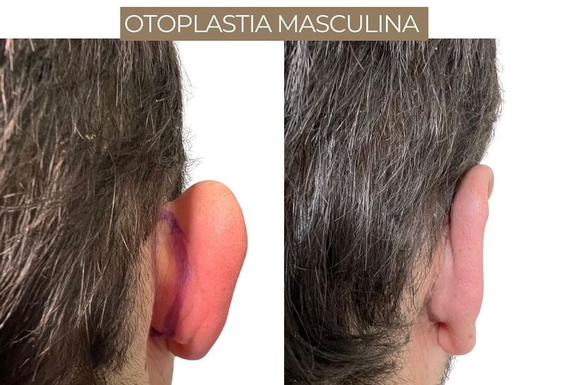Otoplastia antes y después - 871327