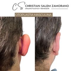 Otoplastia - Dr Christian Salem Zamorano