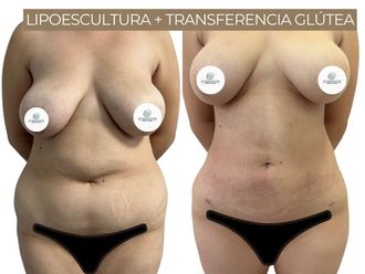 Lipoescultura antes y después - 871328