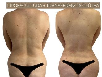 Lipoescultura antes y después - 871329