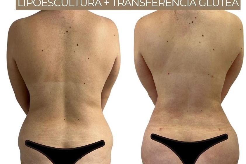 Lipoescultura antes y después - 871329