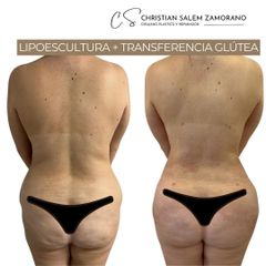 Lipoescultura - Dr Christian Salem Zamorano