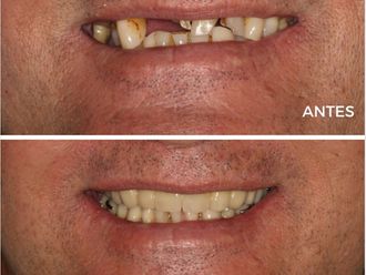 Implantes dentales - 843053