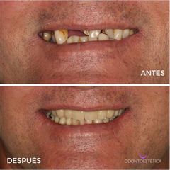 Implantes dentales - Centro Odontoestética