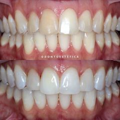 Blanqueamiento dental - Centro Odontoestética