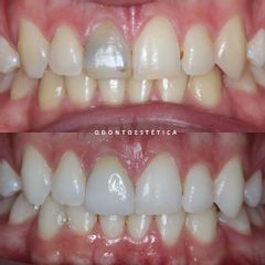 Blanqueamiento dental - Centro Odontoestética