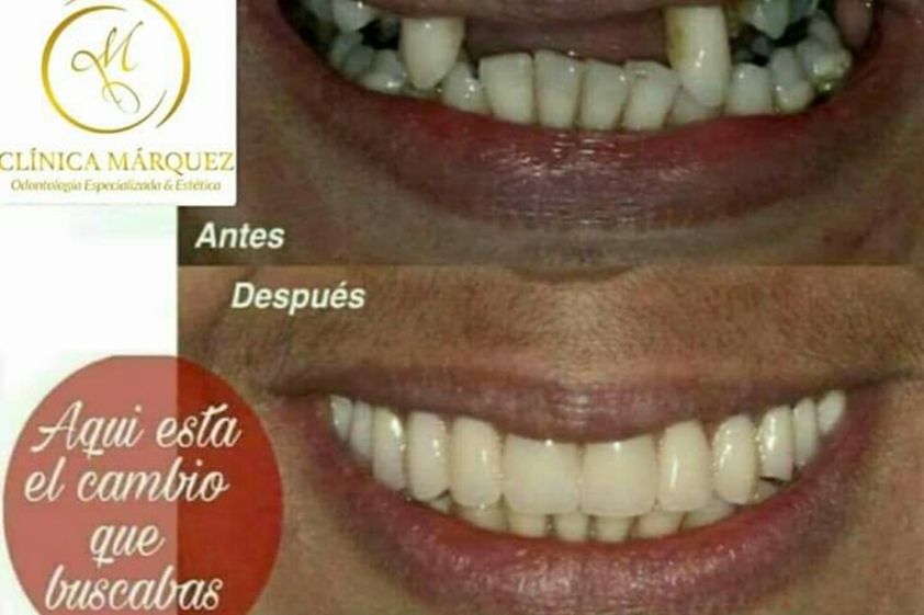 Prótesis dentales antes y después - 632778