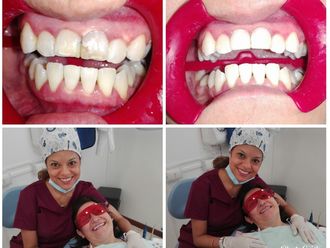 Endodoncia antes y después - 632779