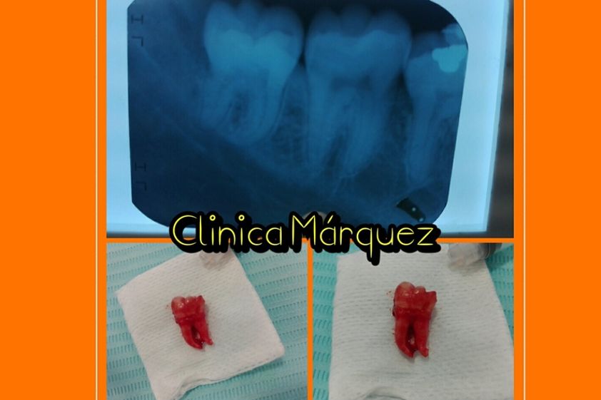 Extracción de dientes antes y después - 635767