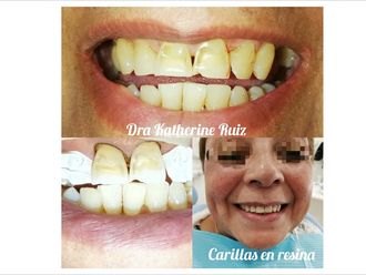 Carillas de porcelana - 639706