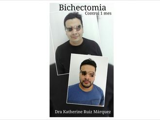 Bolas de Bichat - 639707