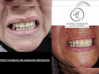 Prótesis dentales - 650259