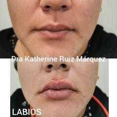 Dra. Katherine Ruiz - Aumento de labios
