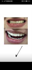 Blanqueamiento dental - antes y después