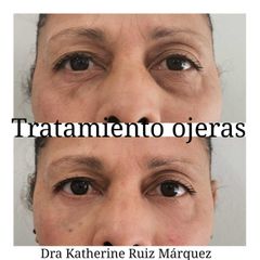 Tratamiento de ojeras - Dra. Katherine Ruiz