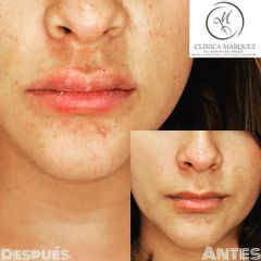 Aumento de labios - Dra. Katherine Ruiz