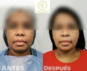 Bichectomía + Lipopapada - Dra. Katherine Ruiz