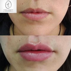 Aumento de labios, ácido hialurónico - Dra. Katherin Ruiz Márquez