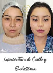 Liposucción - Dra. Katherin Ruiz Márquez