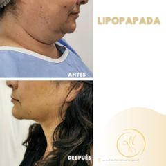 Lipopapada - Dra. Katherin Ruiz Márquez