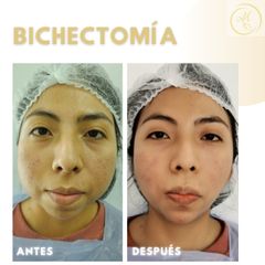 Bichectomía - Dra. Katherin Ruiz Márquez