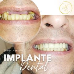 Prótesis dental - Dra. Katherin Ruiz Márquez