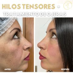 Hilos tensores  y tratamiento para ojeras - Dra. Katherin Ruiz Márquez