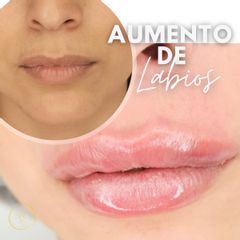 Aumento de labios - Dra. Katherin Ruiz Márquez