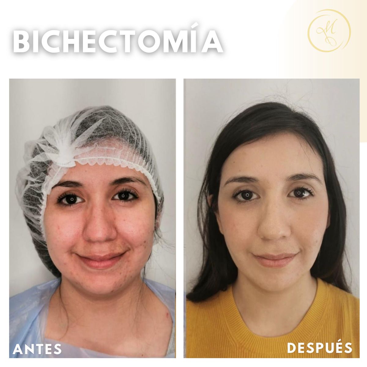 Bolas de Bichat Antes y después - Clinicasesteticas.cl